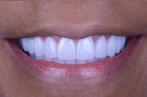 The same smile after cosmetic dental treatment at our dental clinic in Roanoke, VA