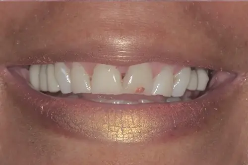 A patient&rsquo;s smile before cosmetic dental treatment at our dental office in Roanoke, VA