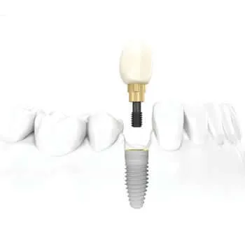 Dental implants in Roanoke, VA at Mill Mountain Dentistry