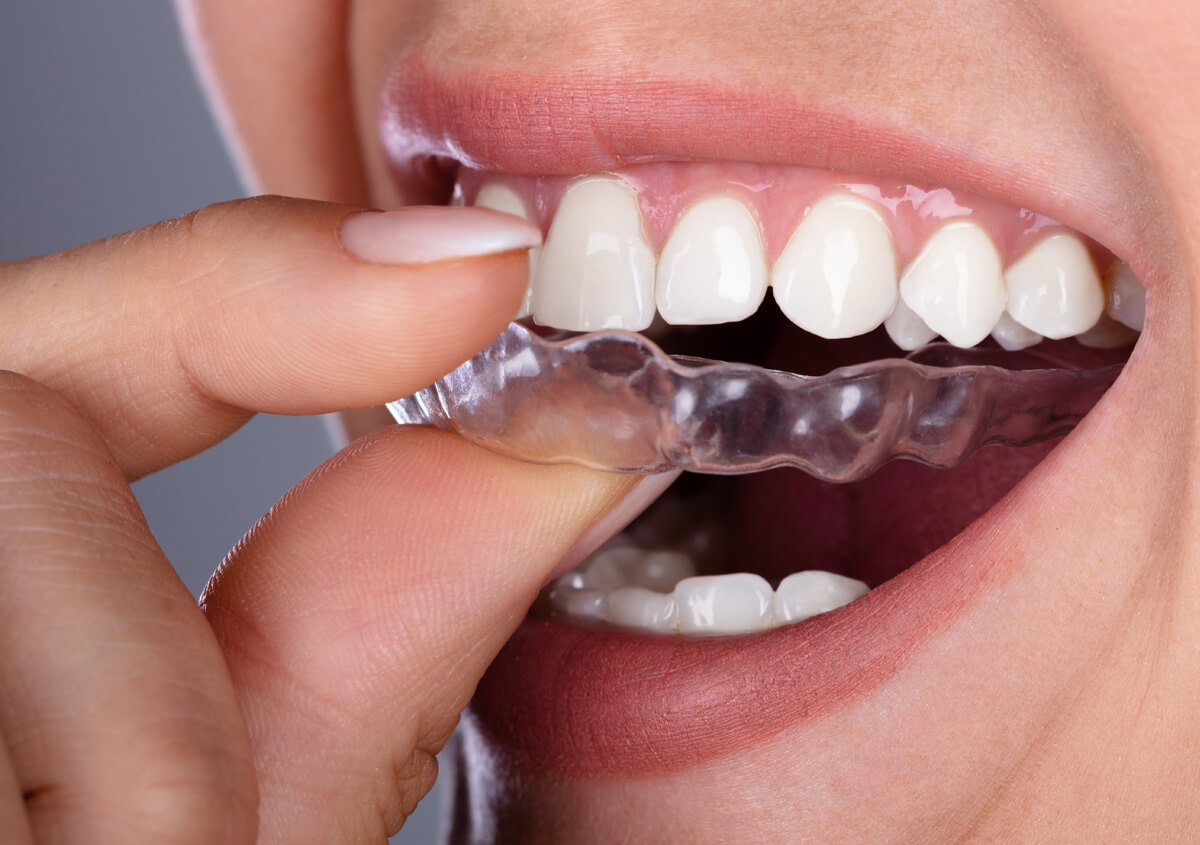 Do You Need a Night Guard? Signs of Teeth Grinding and How to Stop It