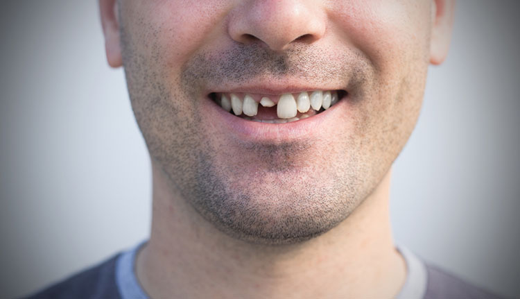 Best dentist in Roanoke VA to treat Chipped Teeth - Mill Mountain Dentistry By Opulent Dental