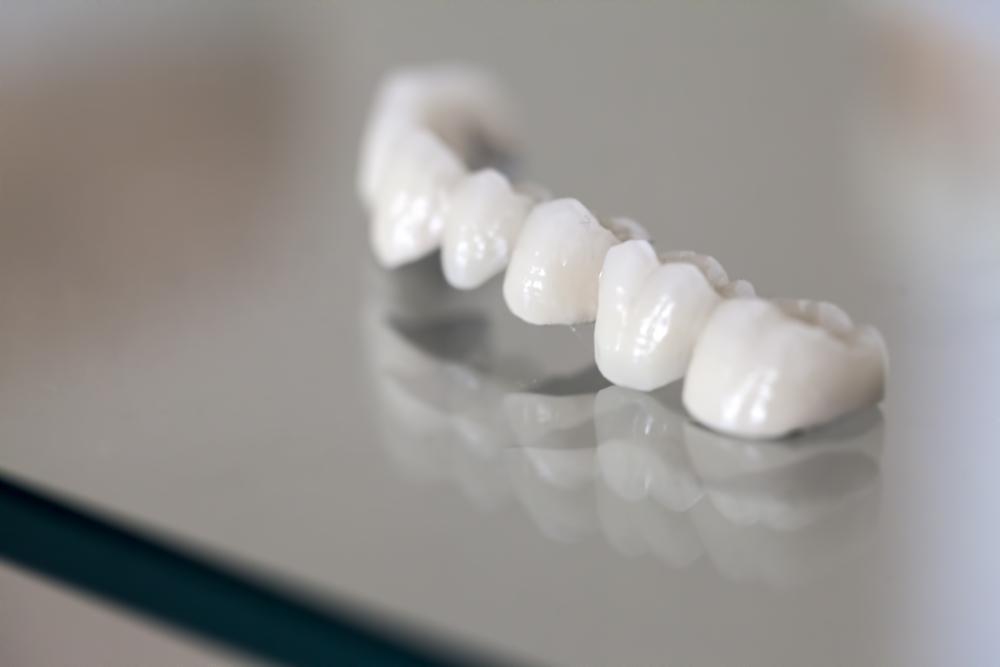 Dental Bridge Cost in Roanoke, VA: Types & What to Expect
