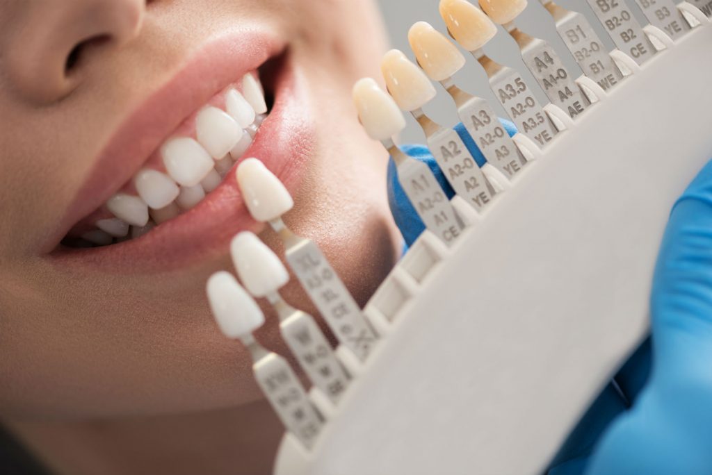 Dental Crown Cost in Roanoke, VA: Types & Lifespan