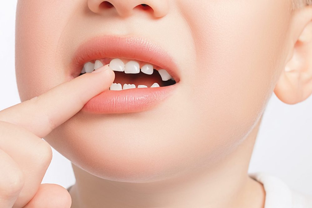 If you are in Roanoke VA, let us be fix your loose teeth in the best manner at Mill Mountain By Opulent Dental - Mill Mountain Dentistry By Opulent Dental
