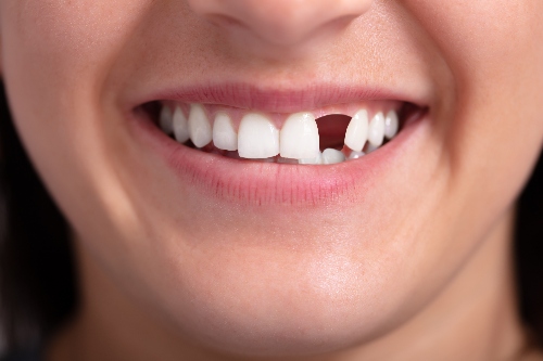 If you are in Roanoke VA, find the best missing teeth solutions at Mill Mountain By Opulent Dental - Mill Mountain Dentistry By Opulent Dental