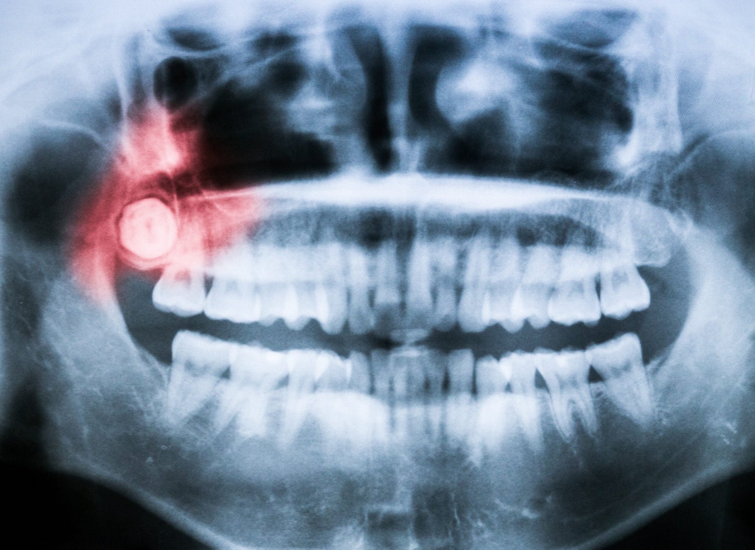 Emergency Tooth Extraction Near Hollins