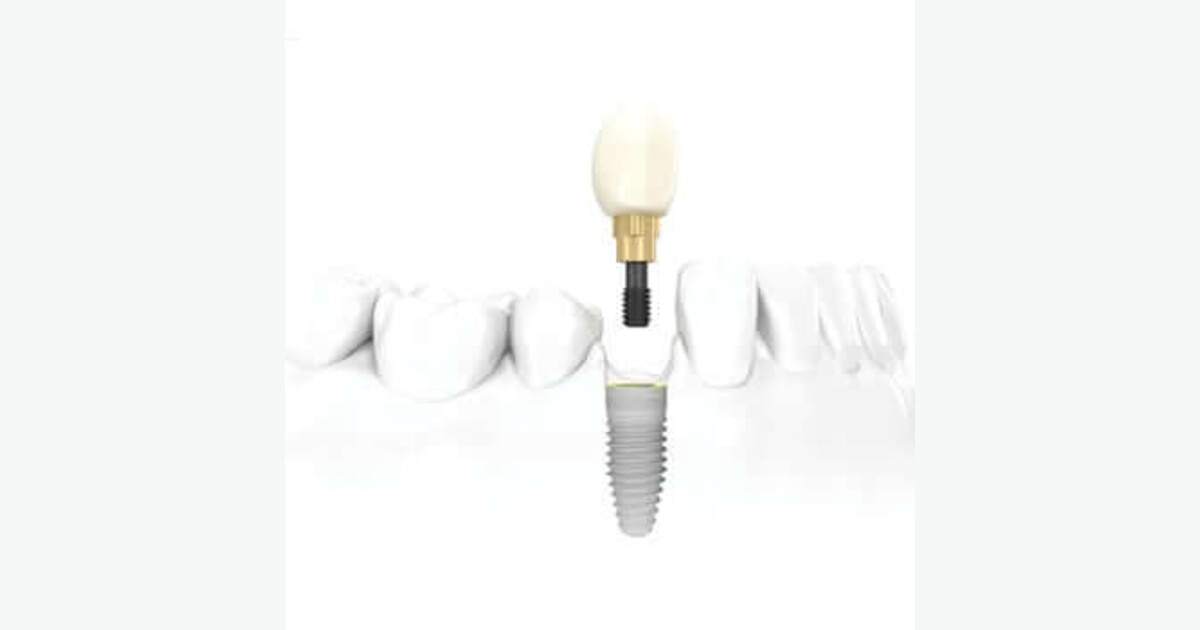 Dental Implants vs. Dentures: Which Is Right for You?