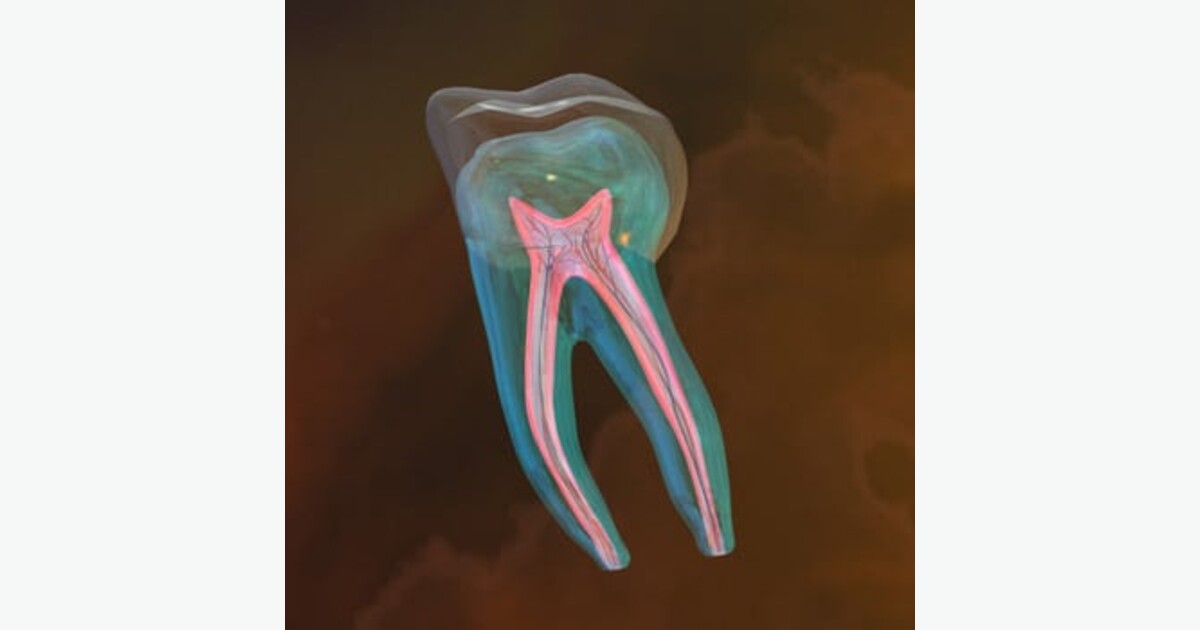 Root Canal Treatment: Signs You Need One and What to Expect